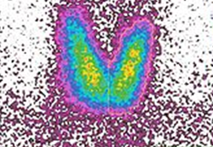 Hashimoto-Thyreoiditis Schilddruese Hashimoto-Thyreoiditis Schilddruese